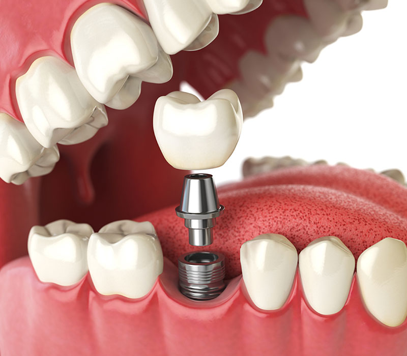 vellore-woods dentistry dental implants
