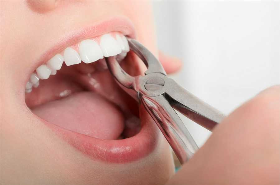 tooth-extraction-in-vaughan-on