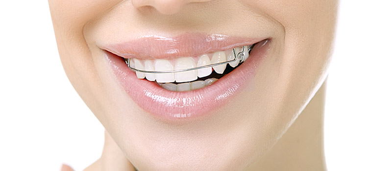 8 tips to keep your retainer safe and clean