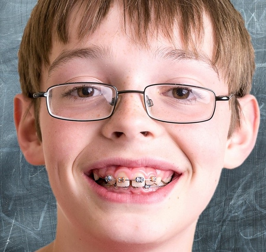 When were Dental Braces Invented?  