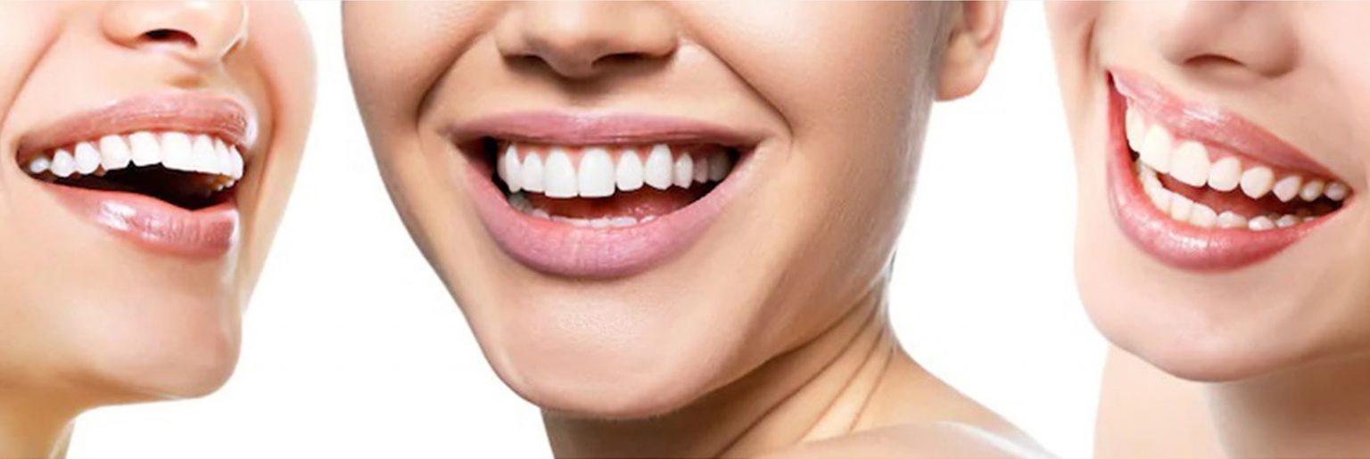 What Happens When You Get Your Teeth Whitened