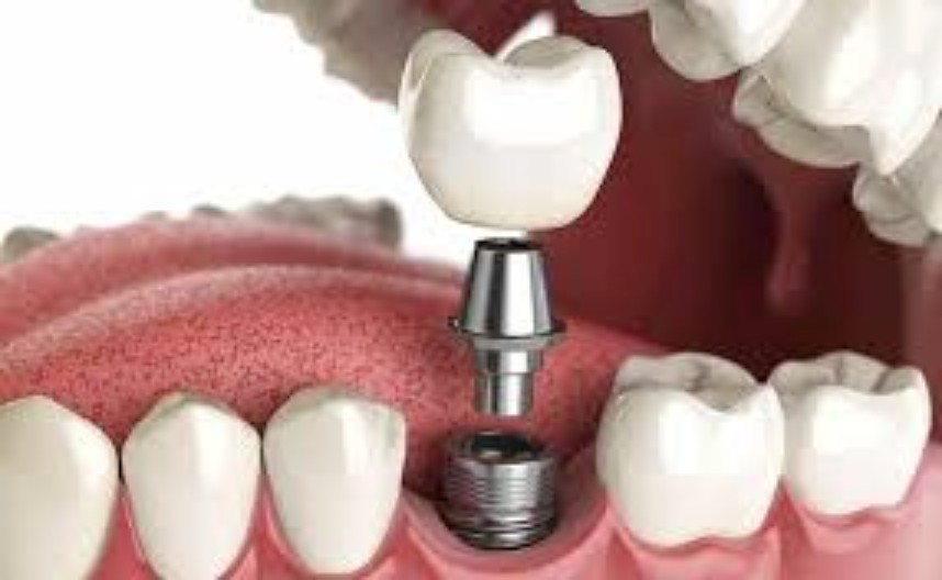 who could benefit from dental implants