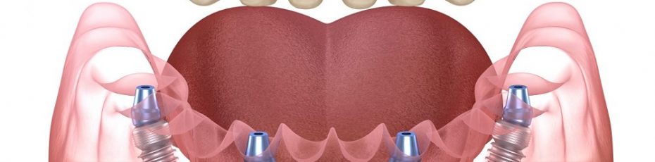 introducing all on 4 dental implants