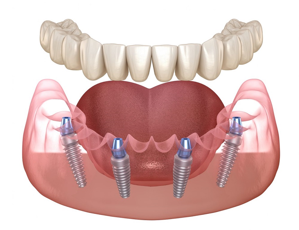introducing all on 4 dental implants