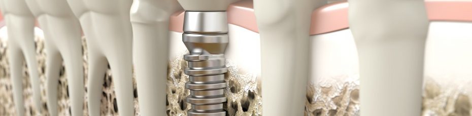five under the radar benefits of dental implants