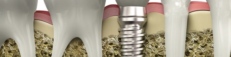what makes dental implants such a good option for replacing teeth