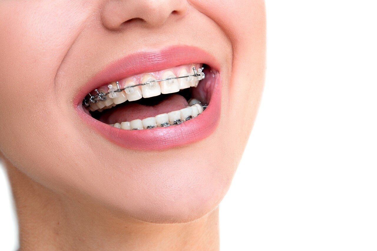 All you need to know about Orthodontic treatment
