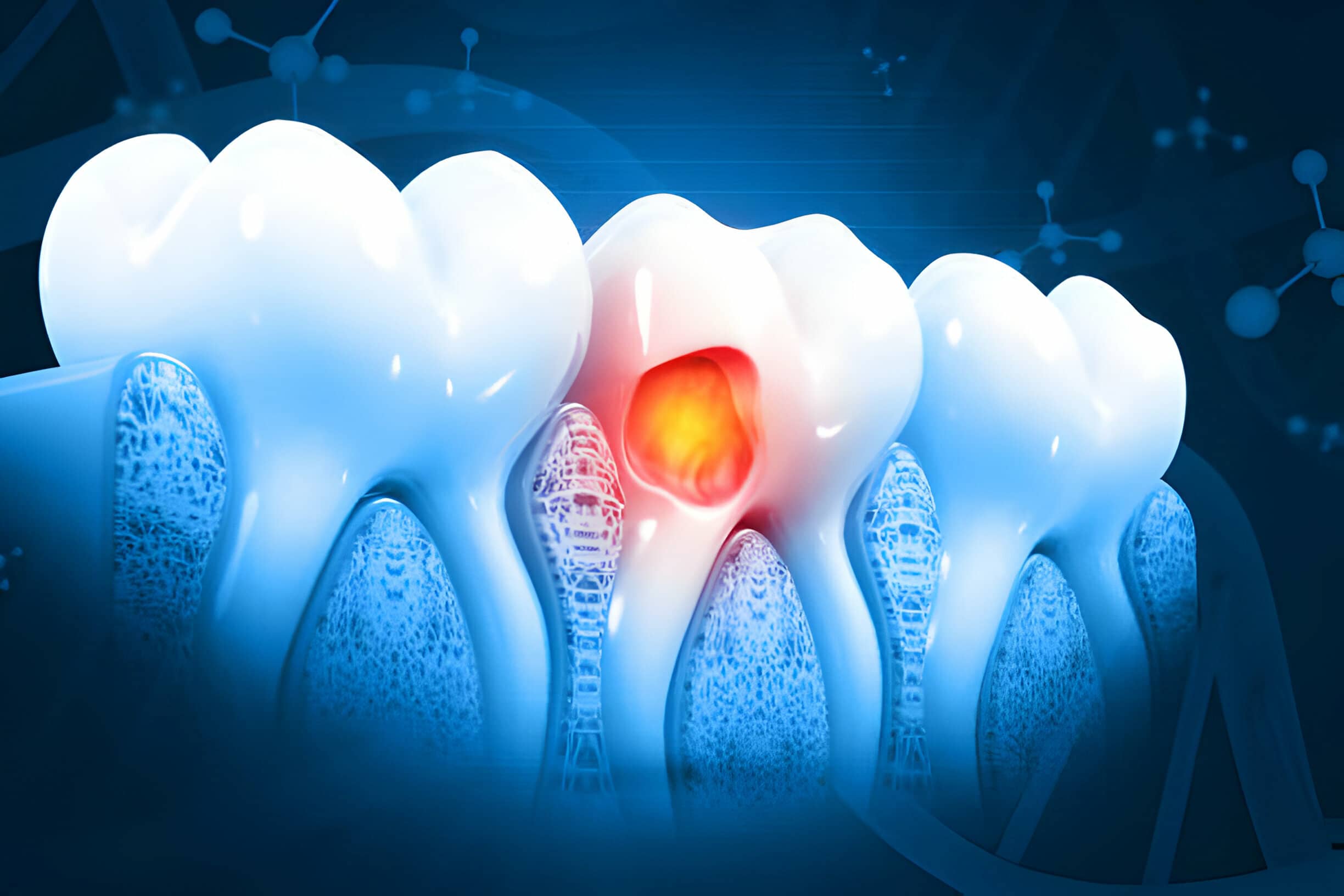 Common Signs and Symptoms of a Tooth Cavity