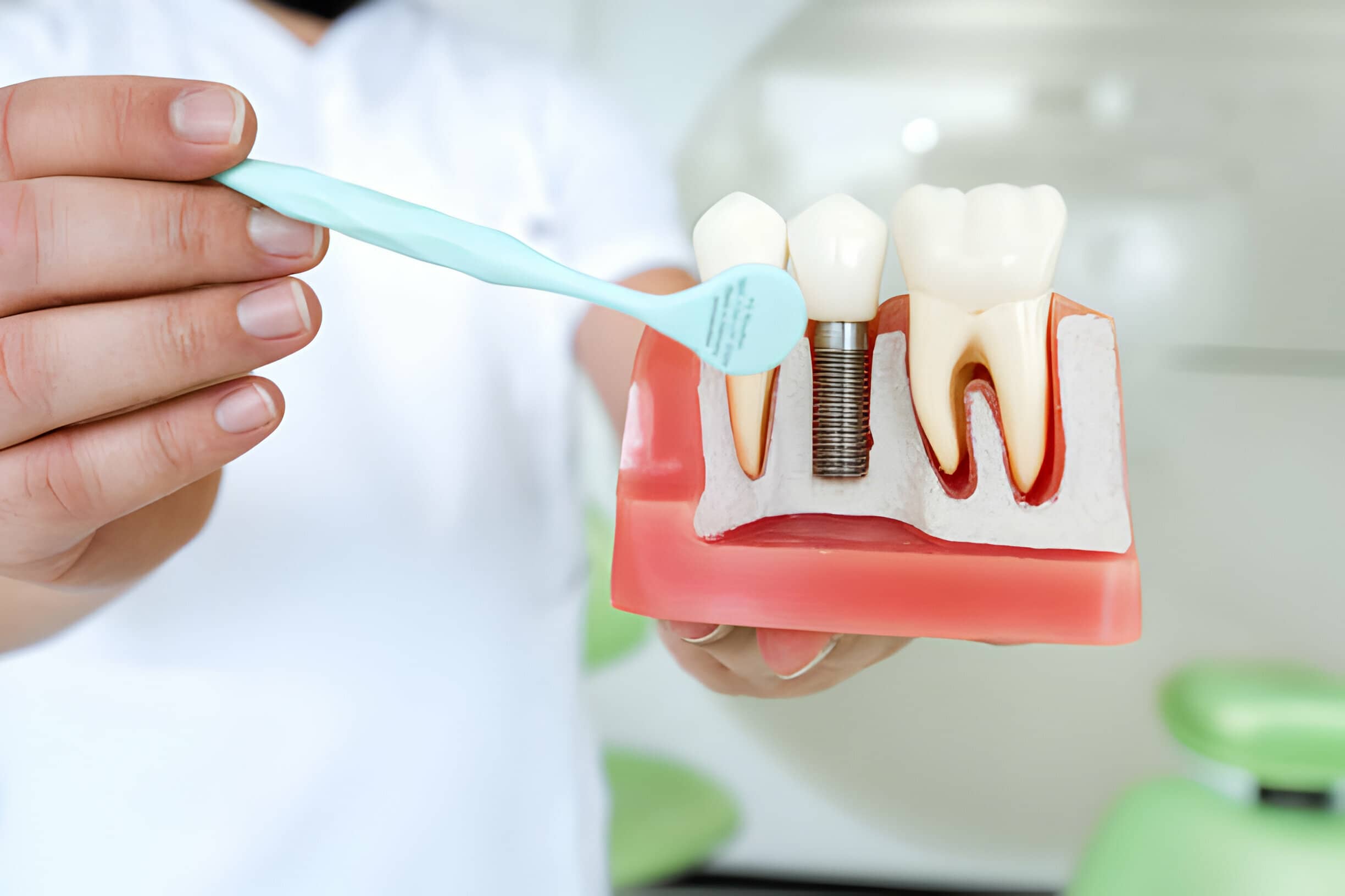 Recovering from Dental Implant Surgery: What to Expect
