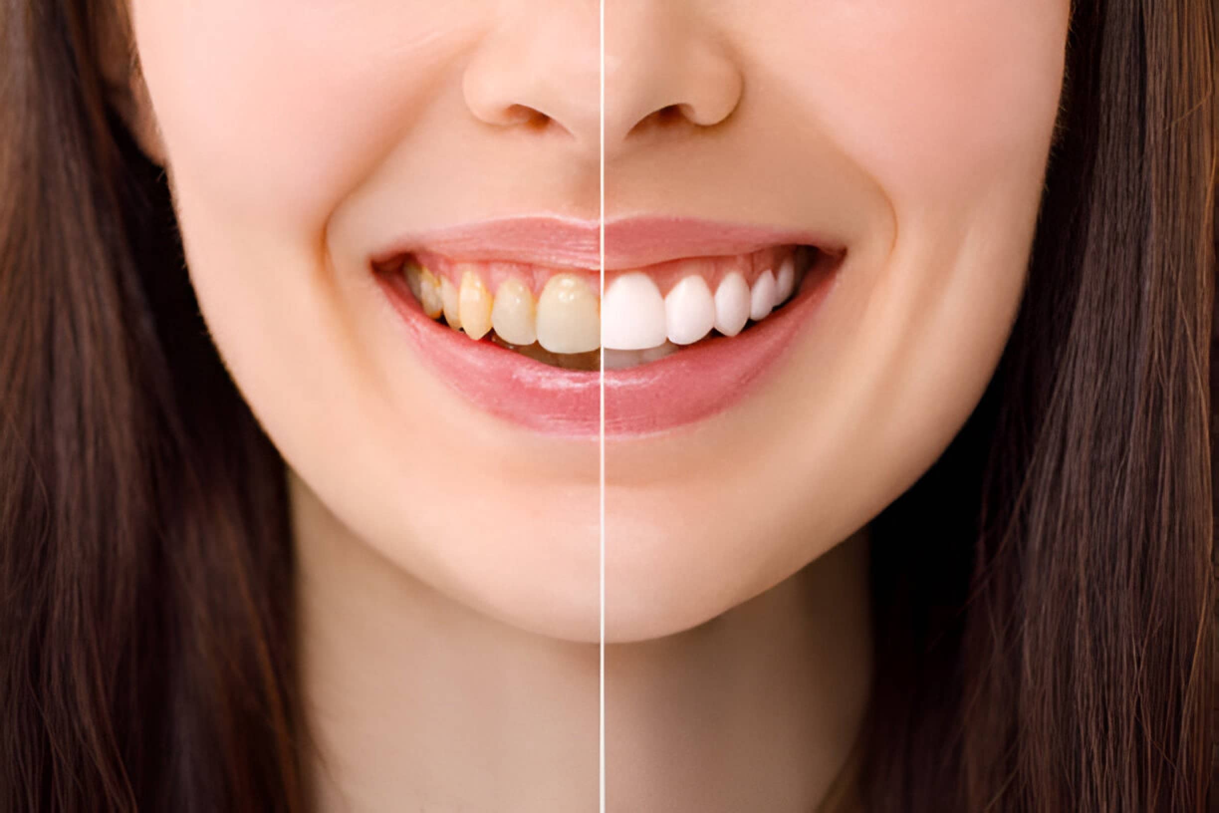 The 10 Best Reasons to Have Your Teeth Professionally Whitened
