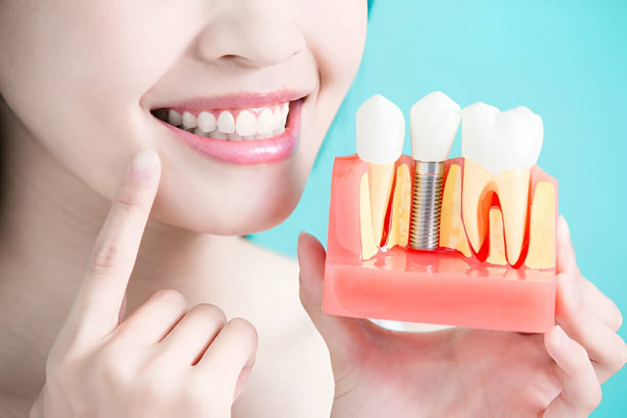 Boosting Confidence and Your Smile with Implants