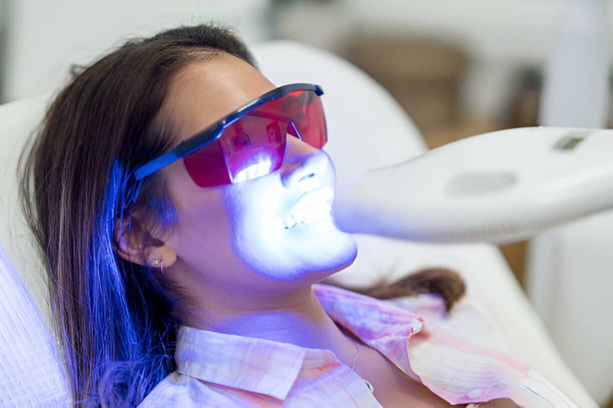 How Many Sessions Does It Take To Whiten Your Teeth?