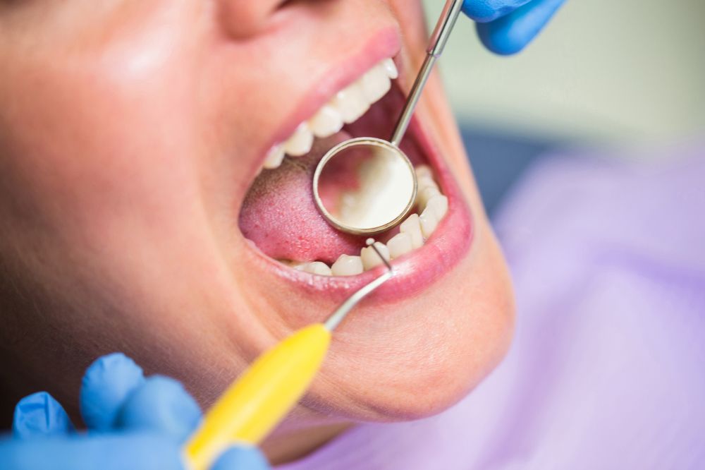 Teeth Rot Under Bonding